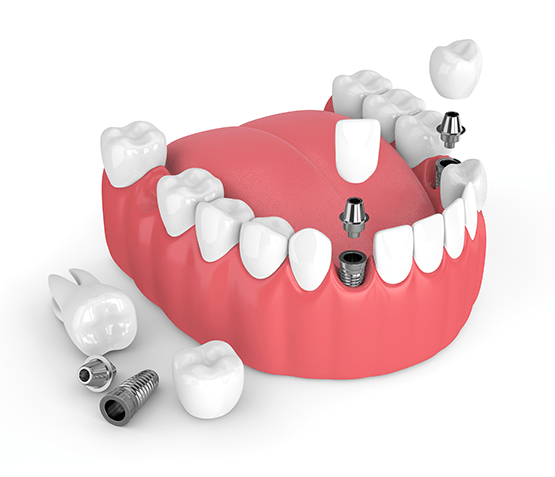 Dental Implants Williamsburg VA